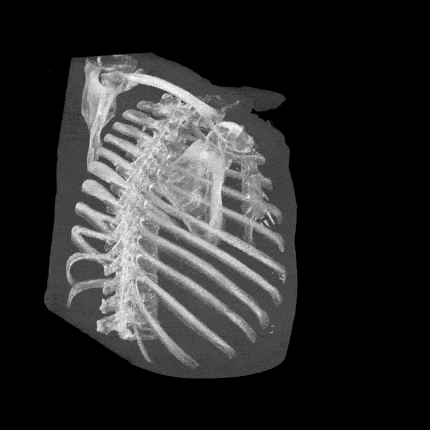 CT reconstruction